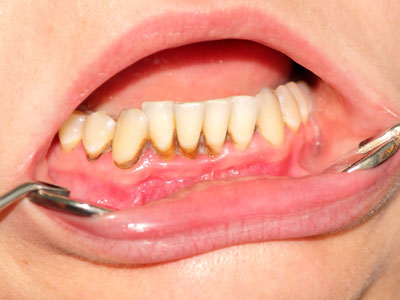 Tartar and dental plaque
